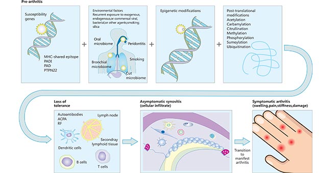 類風濕性關節炎的發病途徑